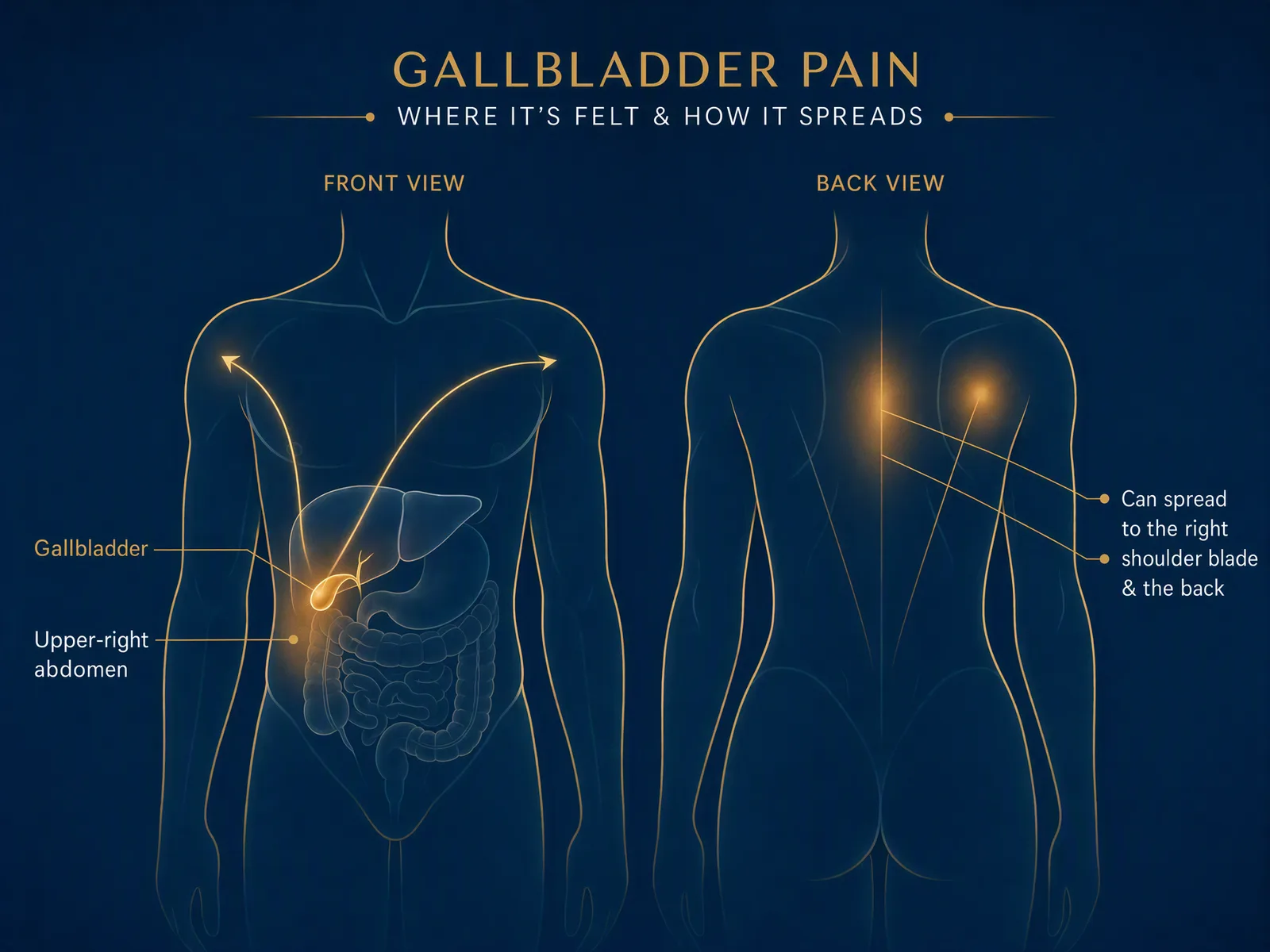 Diagram with front and back body views showing where gallbladder pain is felt: the gallbladder in the upper-right abdomen, spreading to the patient’s right shoulder blade and the back between the shoulder blades.