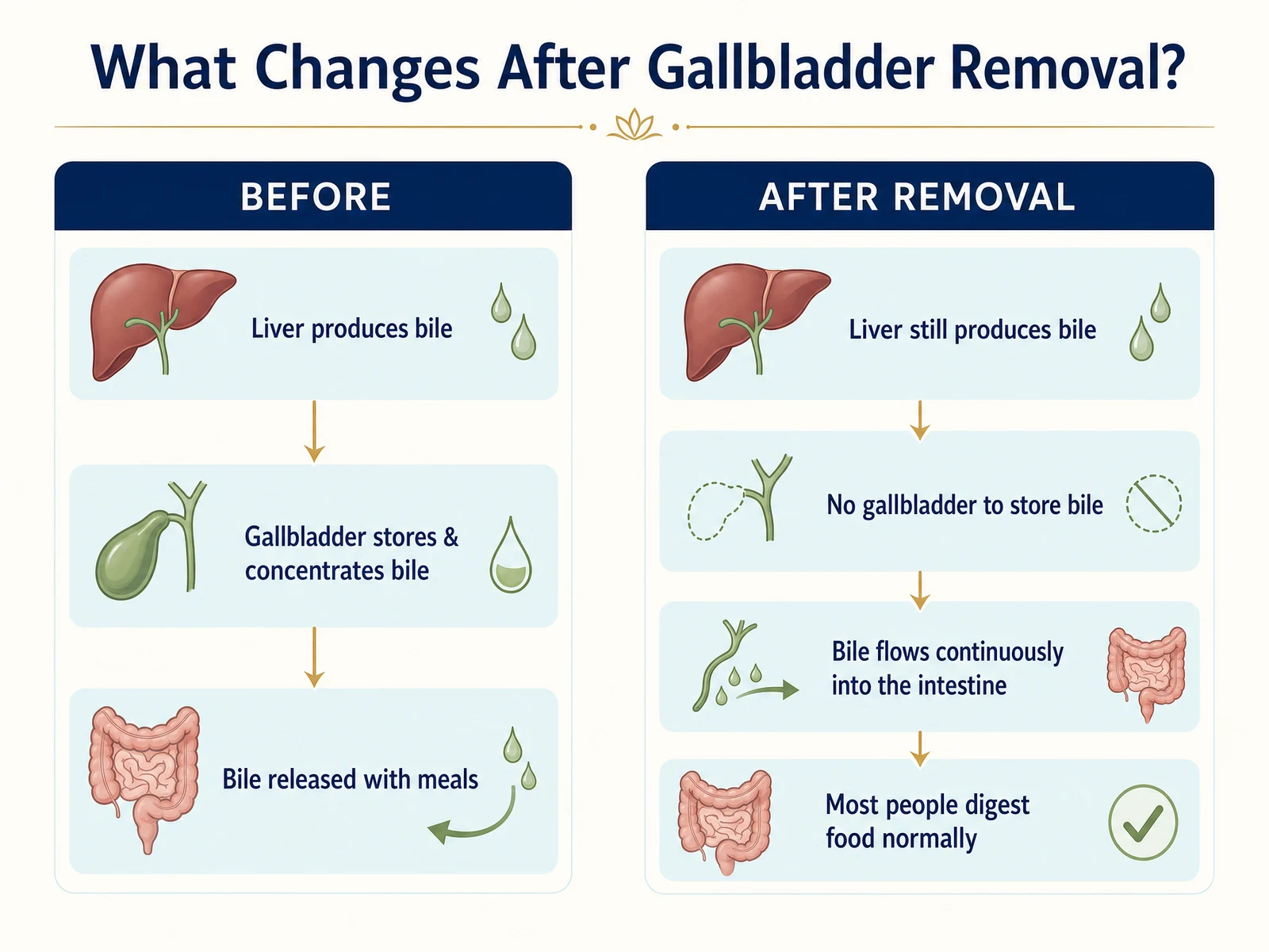 Infographic titled What Changes After Gallbladder Removal comparing before and after: before, the liver produces bile, the gallbladder stores and concentrates it, and bile is released with meals; after removal, the liver still produces bile, there is no gallbladder to store it, bile flows continuously into the intestine, and most people digest food normally.