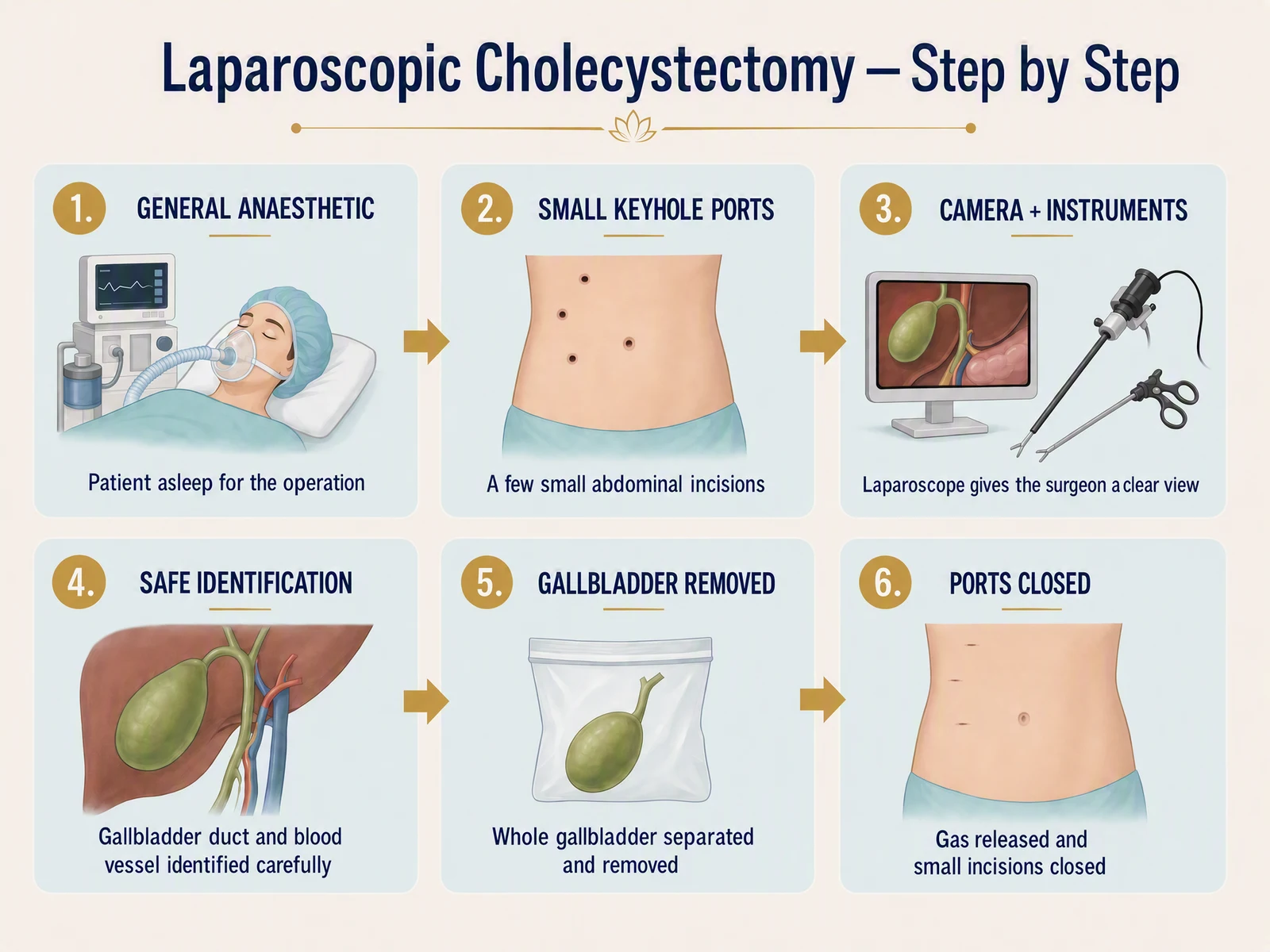 Six-step infographic of laparoscopic cholecystectomy: 1 general anaesthetic (patient asleep), 2 small keyhole ports (a few small abdominal incisions), 3 camera and instruments (the laparoscope gives the surgeon a clear view), 4 safe identification (the gallbladder duct and blood vessel identified carefully), 5 gallbladder removed (the whole gallbladder separated and removed), 6 ports closed (gas released and small incisions closed).